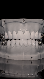 JDWR-V1-CUSTOM-DENTAL-VENEERS