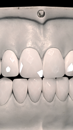 JDWR-V1-CUSTOM-DENTAL-VENEERS