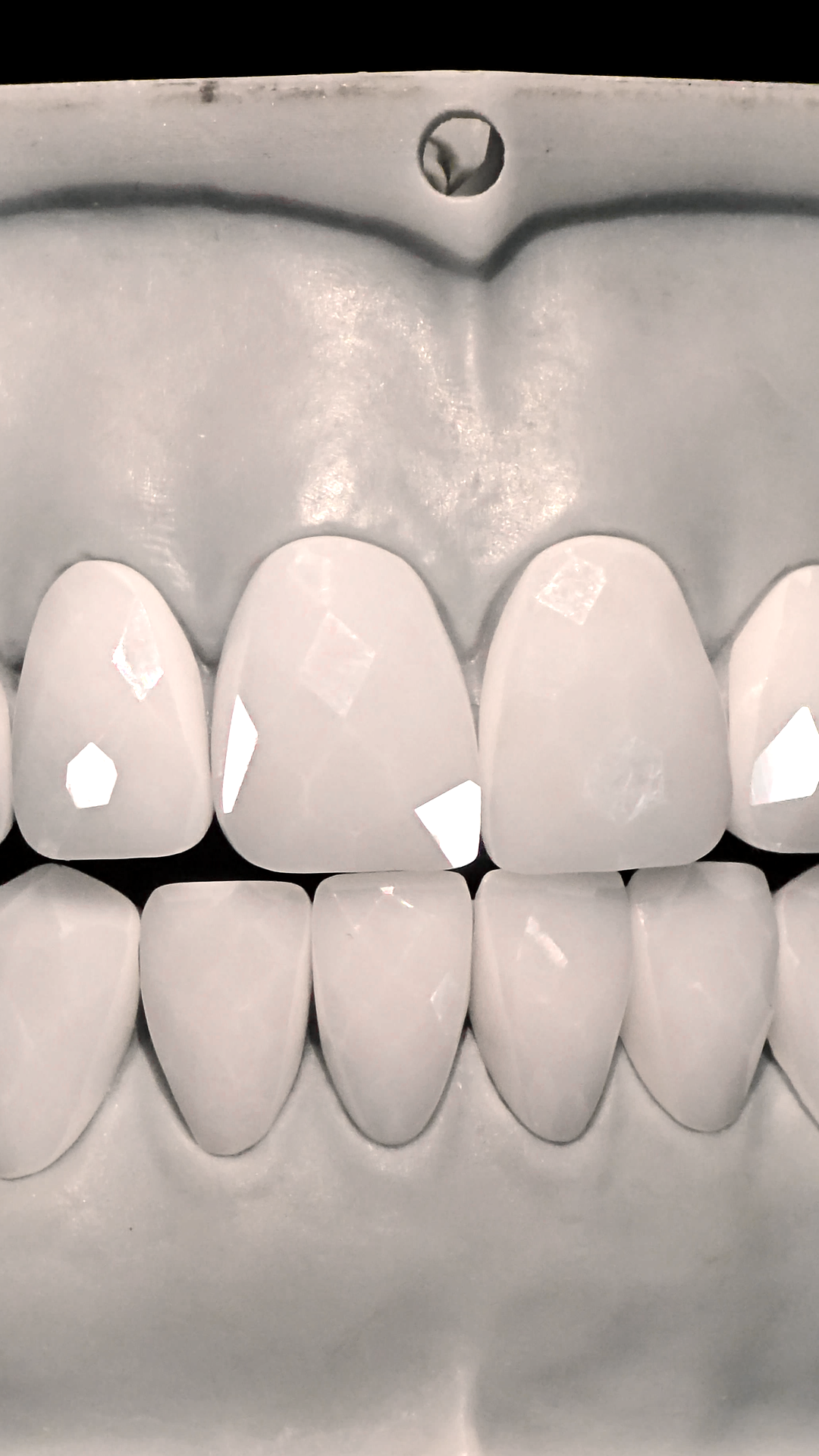 JDWR-V1-CUSTOM-DENTAL-VENEERS